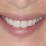 All-Porcelain and Composite Veneers Before & After Patient #577