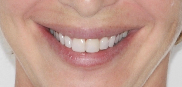 All-Porcelain and Composite Veneers Before & After Patient #577