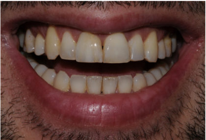 All-Porcelain and Composite Veneers Before & After Patient #578