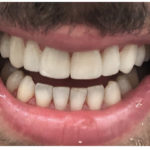 All-Porcelain and Composite Veneers Before & After Patient #578
