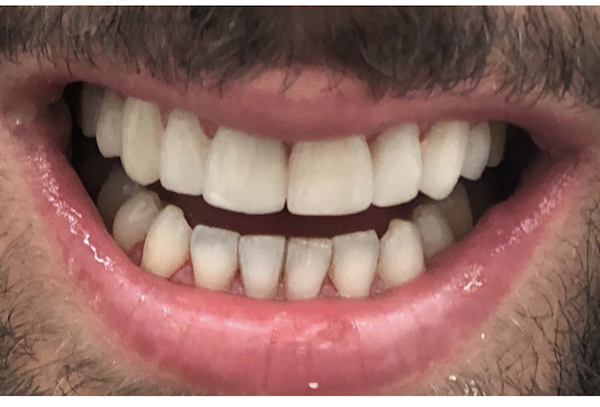 All-Porcelain and Composite Veneers Before & After Patient #578