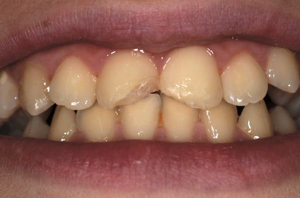 All-Porcelain and Composite Veneers Before & After Patient #588