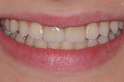 All-Porcelain and Composite Veneers Before & After Patient #588