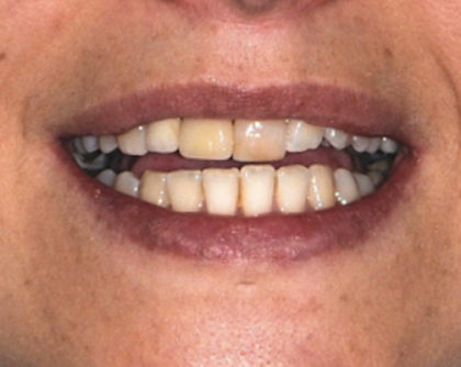 All-Porcelain and Composite Veneers Before & After Patient #587