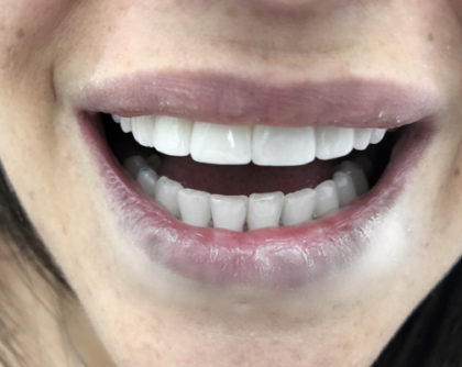 All-Porcelain and Composite Veneers Before & After Patient #587