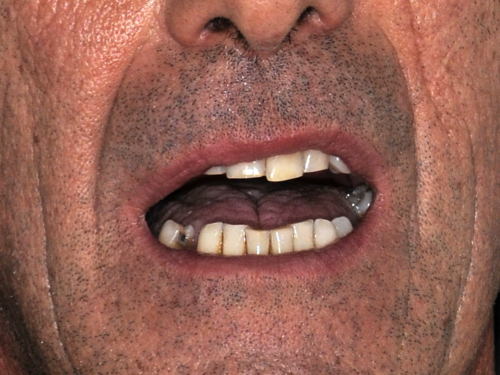 All-Porcelain and Composite Veneers Before & After Patient #574