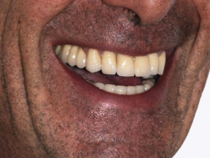 All-Porcelain and Composite Veneers Before & After Patient #574