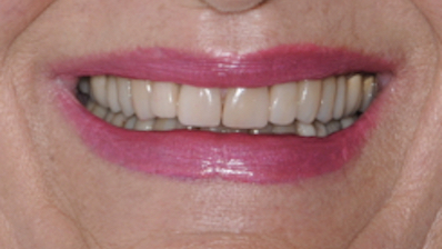 All-Porcelain and Composite Veneers Before & After Patient #586