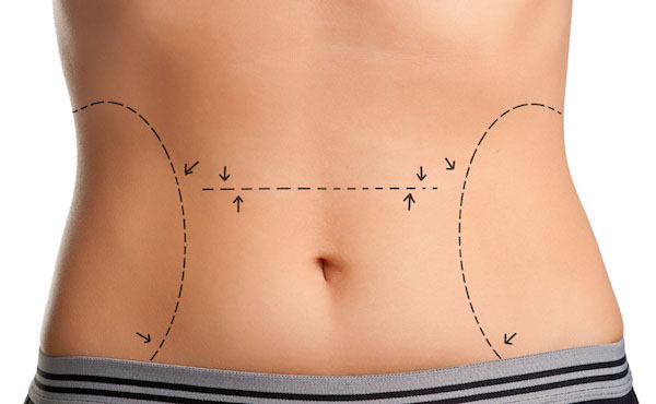 Tummy Tuck (Abdominoplasty)