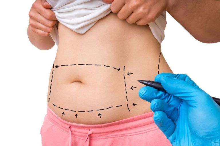 Liposuction